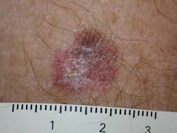 However, those who are diagnosed with later stage disease have lower survival rates. Melanoma Symptoms Signs And Abcd Mnemonic