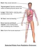 Image result for what is treatment for radiation poisoning