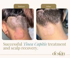 Image result for Tinea Capitis