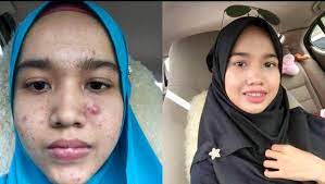 Check spelling or type a new query. Ubat Gigi Kecut Jerawat Pertanyaan F