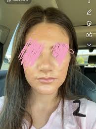 Hi everyone! I had my nose operation