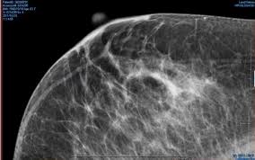 Abnormalities such as cancerous tumors usually appear brighter because they are denser. Longer Mammogram Evaluation Does Not Reduce Breast Cancer Detection Imaging Technology News