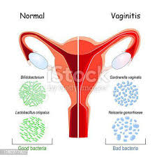 Image result for Vaginitis