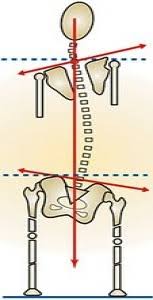 Image result for Functional Leg Length Discrepancy