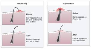 People with naturally coarse and curly hair tend to be more prone to getting ingrowns, but really, anyone can get them and tons of people do. Are You Making This One Shaving Mistake That Causes Ingrown Hairs Emaxhealth