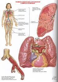 Dispnea acuta in paziente oncologica. Http Www Fisiokinesiterapia Biz Download Tromboembolia Pdf