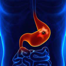 Cancer Del Estomago Sintomas Y Factores De Riesgo