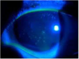 Help was capable of eliminating the viral reservoir via retrograde transport from corneas to trigeminal ganglia. Thygeson S Superficial Punctate Keratitis Tspk A Paediatric Case Report And Review Of The Literature Bmc Ophthalmology Full Text