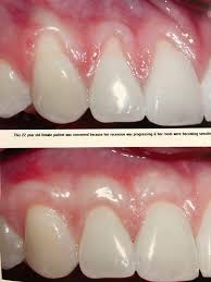Check spelling or type a new query. Can You Reverse Receding Gum Lines Quora