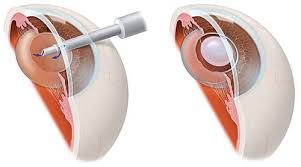 Que son las cataratas en los ojos. Catarata En Los Ojos Diagnostico Y Tratameintos Clinica Sancho