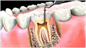 Do Root Canals Hurt Root Canal Root Canal Treatment Dentistry