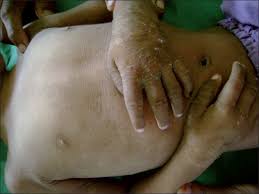Sjogren Larsson Syndrome A Case Report Of A Rare Disease Gupta S P Mittal A Maini B Gupta S Indian Dermatol Online J
