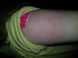 Tetanusauffrischung Mit 5 Jahren Arm Hart Rot Geschwollen Oder Eine Entzundung Gesundheit Und Medizin Auffrischung