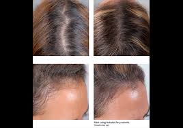 Good sources include avocado, sunflower seeds, almonds, and spinach. The One Supplement That Covers Every Type Of Hair Loss
