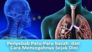 Jul 05, 2014 · kesan utama pencemaran udara adalah ke atas kesihatan manusia. Gejala Paru Paru Basah Penyebab Dan Cara Mengobatinya