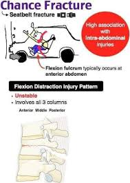 Image result for Chance Fracture