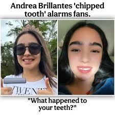 NETIZENS are expressing concern for Andrea Brillantes after noticing that  she has a broken tooth and a swollen lip. In her latest Instagram post with  the caption "birthday week", the apparent chip