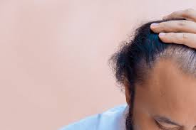 Our hair shows the world who we are—or who we want to be. Can Brushing Too Often Cause Hair Loss Estegrande Hair Transplant
