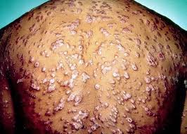 Just a few decades ago syphilis was the subject of the most infamous public health study ever carried out in the united states. Ruckkehr Der Syphilis Arzte Warnen Vor Dem Chamaleon Der Medizin Scinexx De