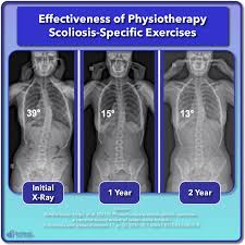 Scoliosis Treatment For Children And Teens Scoliosis Care