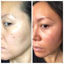 Musely dark spot cream reviews. Pin On Dark Spot Removal