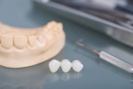 Hochwertig Gunstig Zahnbrucken Aus Der Gelencser Dental Zahnklinik