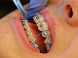 Brackets are attached by archwire, small metal bands between brackets. Orthodontic Terms East Lansing Orthodontist Peters Orthodontics