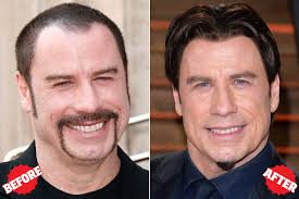 Celebrities Who Had Hair Transplant Surgery