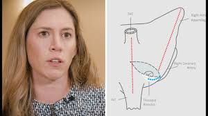 Dr. Katharine Harrington: Lesion Set Selection for Stroke Risk During  Concomitant AFib Surgery