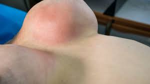 Acute mastitis in women is a sudden infectious inflammation caused usually by the bacterium staphylococcus aureus, or sometimes by streptococcus organisms. Mastitis All You Need To Know Peanut