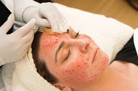 What Is a Vampire Facial? PRP, Benefits & Costs Explained