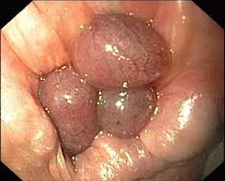 Die lage der klumpen bestimmt, ob die hämorrhoide eine externe oder interne ist. Gummibandligatur Hamorrhoiden Wikipedia