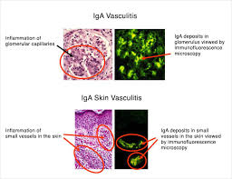 Image result for Vasculitis