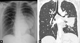 After reading your post, i would not think it is sarcoidosis. Lung Infections The Radiologist S Perspective Sciencedirect