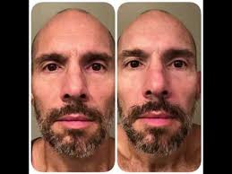 Sio necklift and eye & smile lift patches are particularly powerful in the fight against jowls. I Pulled An All Nighter Lipgloss Aftershave
