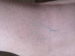 Sind Das Schon Krampfadern Schmerzen Gesundheit Medizin