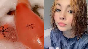 Aquagenic urticaria: Teen suddenly develops allergy to water