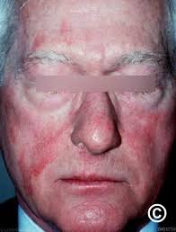 Image result for Photodermatitis