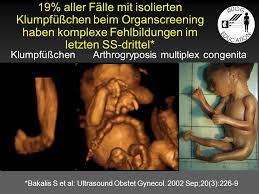 Zwischen 90 und 250 €. Isuog Education 2008 Fetale Syndrome Barbara Pertl Lkh Deutschlandsberg Univ Frauenklinik Graz Ppt Herunterladen