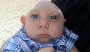 Image result for images of babies with zika