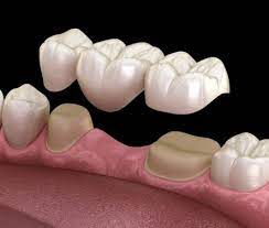 Zahnbrucke Aus Vollkeramik Zahnbrucke Kosten Zahnbrucke Oder Implantat Dentalreisenpolen