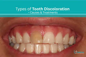 Image result for Tooth Discoloration