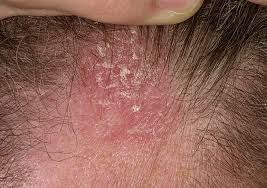 This goes for both scalp and face, or anywhere else. Causes And Treatment For Seborrheic Dermatitis And Related Hair Loss Thick Hair Remedies Help Hair Loss Hair Loss Treatment