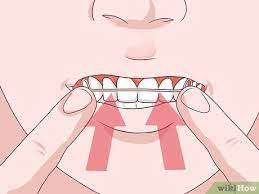 Hello everyone!today's video is about how i remove and insert my retainers along with my permanent one. How To Put On A Retainer 9 Steps With Pictures Wikihow