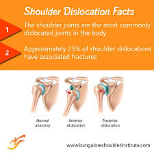 Read More About Shoulder Dislocation Here Http Bangaloreshoulderinstitute Com Shoulder Dislocati Shoulder Dislocation Shoulder Arthroscopy Shoulder Surgery