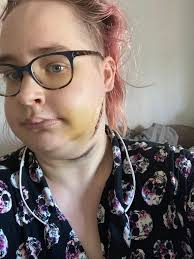 Dec 2022-Feb 2023 was a medically chaotic time for me….(posting out of  order a bit as the jaw was the post I had all ready to go before they redid  the morgue