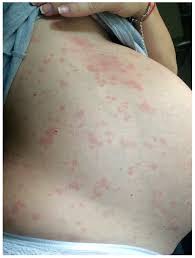 Image result for pruritic urticarial papules and plaques of pregnancy
