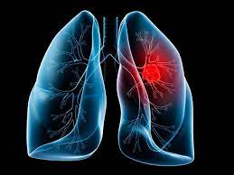 Making your home and vehicles smoke free can reduce secondhand smoke exposure among. 9 Of The Worst Diseases You Can Get From Secondhand Smoke State Of Tobacco Control American Lung Association