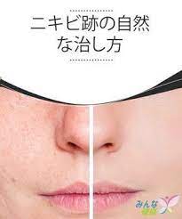 ニキビ跡の自然な治し方 若い頃 不快で厄介なニキビ に皆 悩まされたのではないでしょうか 永久的に肌にダメージを与え 見苦しい跡を残してしまい 耐え難く不快に感じている人もいるのではないでしょうか ニキビ 跡とは ニキビの炎症過程によって形成されてしまった
