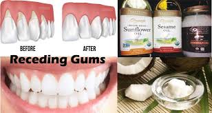 Natural Home Remedies For Receding Gums Healthy Diet Recipes Gum Health Gum Care Natural Home Remedies